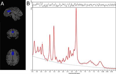 Evidence That Cannabis Exposure, Abuse, and Dependence Are Related to Glutamate Metabolism and Glial Function in the Anterior Cingulate Cortex: A 1H-Magnetic Resonance Spectroscopy Study